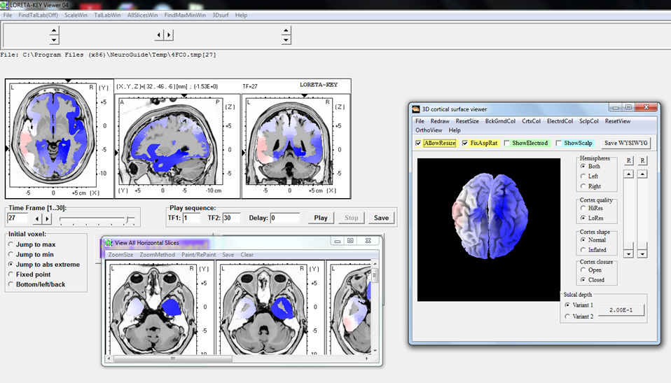 Live Loreta Neurofeedback Barbara Paul Blume Phd 0989